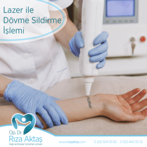 Lazer Dövme Sildirme İşlemi